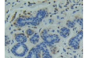 DAB staining on IHC-P; Samples: Human Breast cancer Tissue (GSK3 alpha 抗体  (AA 115-409))