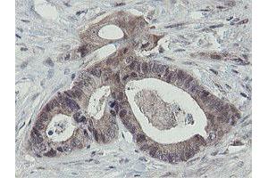 Immunohistochemical staining of paraffin-embedded Adenocarcinoma of Human colon tissue using anti-OTUB1 mouse monoclonal antibody. (OTUB1 抗体)