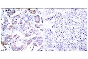 Immunohistochemical analysis of paraffin-embedded human breast carcinoma tissue, using NF-κB p65 (Ab-254) antibody (E021010). (NF-kB p65 抗体)