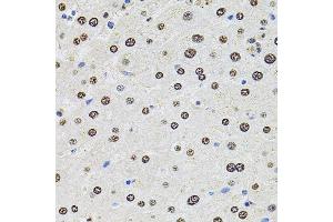Immunohistochemistry of paraffin-embedded human liver damage using U2SURP antibody (ABIN6132839, ABIN6149759, ABIN6149760 and ABIN6220240) at dilution of 1:100 (40x lens). (SR140 抗体  (AA 705-1029))