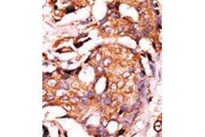 Formalin-fixed and paraffin-embedded human cancer tissue reacted with the primary antibody, which was peroxidase-conjugated to the secondary antibody, followed by AEC staining. (GUCY1A1 抗体  (N-Term))
