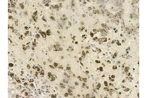 ABIN6260687 and ABIN6277042 at 1/100 staining human melanoma by IHC-P.
