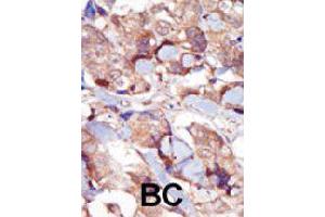 Immunohistochemistry (Formalin/PFA-fixed paraffin-embedded sections) of human breast carcinoma with MYLK3 polyclonal antibody , followed by peroxidase-conjugated secondary antibody and DAB staining. (MYLK3 抗体  (AA 40-69))
