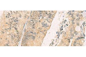 Immunohistochemistry of paraffin-embedded Human colorectal cancer tissue using THG1L Polyclonal Antibody at dilution of 1:70(x200) (THG1L 抗体)