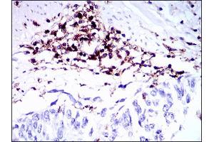 Immunohistochemical analysis of paraffin-embedded esophageal cancer tissues using PTPRC mouse mAb with DAB staining.