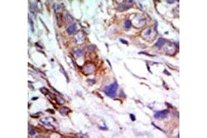 IHC analysis of FFPE human breast carcinoma tissue stained with the ERK5 antibody (MAPK7 抗体  (AA 776-805))