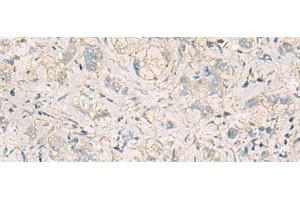 Immunohistochemistry of paraffin-embedded Human liver cancer tissue using WDR37 Polyclonal Antibody at dilution of 1:50(x200) (WDR37 抗体)