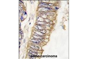 Formalin-fixed and paraffin-embedded human colon carcinoma tissue reacted with MET/HGFR Antibody (ABIN387741 and ABIN2837999) , which was peroxidase-conjugated to the secondary antibody, followed by DAB staining. (c-MET 抗体  (Catalytic Domain))