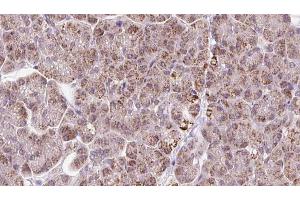 ABIN6273247 at 1/100 staining Human pancreas cancer tissue by IHC-P. (ARHGEF25/GEFT 抗体  (Internal Region))