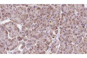 ABIN6273247 at 1/100 staining Human pancreas cancer tissue by IHC-P. (ARHGEF25/GEFT 抗体  (Internal Region))