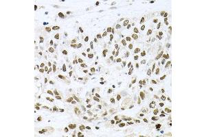 Immunohistochemistry of paraffin-embedded human lung cancer using BCCIP antibody. (BCCIP 抗体)