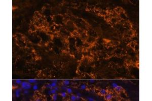 Immunofluorescence analysis of Human kidney cancer using SLC7A9 Polyclonal Antibody at dilution of 1:100. (SLC7A9 抗体)