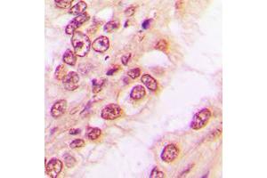 Immunohistochemical analysis of PAWR staining in human breast cancer formalin fixed paraffin embedded tissue section. (PAWR 抗体  (C-Term))