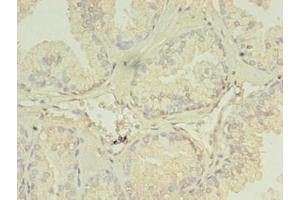 Immunohistochemistry of paraffin-embedded human prostate cancer using ABIN7151288 at dilution of 1:100 (TRIM9 抗体  (AA 1-550))