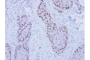 IHC-P Image Immunohistochemical analysis of paraffin-embedded MDAMB-468 Xenograft, using RFC4, antibody at 1:100 dilution. (RFC4 抗体)