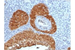 Formalin-fixed, paraffin-embedded human cervix stained with P16INK4a Recombinant Mouse Monoclonal Antibody (rCDKN2A/4845). (Recombinant CDKN2A 抗体)
