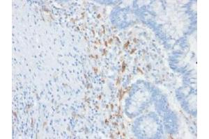 IHC testing of FFPE human colon carcinoma with DC-SIGN antibody (clone C209/1781). (DC-SIGN/CD209 抗体)