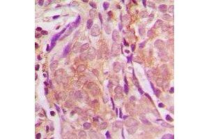 Immunohistochemical analysis of ZNF397 staining in human breast cancer formalin fixed paraffin embedded tissue section. (ZNF397 抗体  (N-Term))