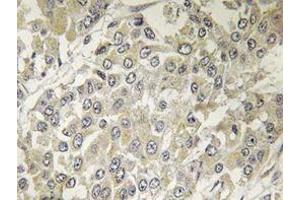 Immunohistochemistry analyzes of p70 S6K antibody in paraffin-embedded human breast carcinoma tissue. (RPS6KB1 抗体)