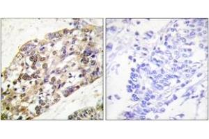 Immunohistochemistry analysis of paraffin-embedded human breast carcinoma tissue, using Histone H3 (Ab-28) Antibody. (Histone 3 抗体  (AA 13-62))