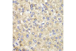 Immunohistochemistry of paraffin-embedded human liver cancer using HADH antibody at dilution of 1:100 (400x lens). (HADH 抗体)