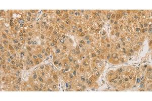 Immunohistochemistry of paraffin-embedded Human liver cancer using PGK2 Polyclonal Antibody at dilution of 1:50 (PGK2 抗体)