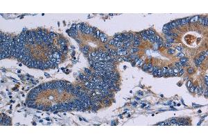 Immunohistochemistry of paraffin-embedded Human colon cancer tissue using ITK Polyclonal Antibody at dilution 1:50 (ITK 抗体)