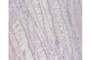 Immunohistochemistry of paraffin-embedded human colon cancer using ABIN7163507 at dilution of 1:50 (FUCA2 抗体  (AA 29-465))