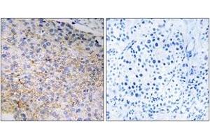 Immunohistochemistry analysis of paraffin-embedded human breast carcinoma tissue, using NOX3 Antibody.