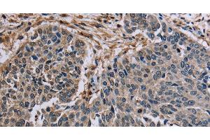 Immunohistochemistry of paraffin-embedded Human lung cancer tissue using PNPT1 Polyclonal Antibody at dilution 1:40 (PNPT1 抗体)