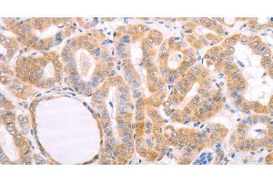 Immunohistochemistry of paraffin-embedded Human thyroid cancer tissue using pVHL Polyclonal Antibody at dilution 1:40 (VHL 抗体)