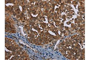 The image on the left is immunohistochemistry of paraffin-embedded Human ovarian cancer tissue using ABIN7191460(MIG7 Antibody) at dilution 1/35, on the right is treated with synthetic peptide. (TOX4 抗体)