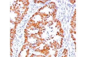 IHC staining of human colon carcinoma with p53 antibody (BP53-12).