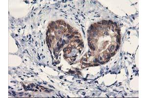 Immunohistochemical staining of paraffin-embedded Adenocarcinoma of Human breast tissue using anti-PDE4B mouse monoclonal antibody. (PDE4B 抗体)