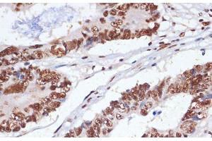 Immunohistochemistry of paraffin-embedded Human colon carcinoma using PELP1 Polyclonal Antibody at dilution of 1:100 (40x lens). (PELP1 抗体)