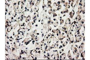 Immunohistochemical staining of paraffin-embedded Adenocarcinoma of Human colon tissue using anti-ACOT12 mouse monoclonal antibody. (ACOT12 抗体)