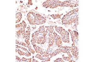 Immunohistochemistry of paraffin-embedded Human thyroid cancer using FRMD6 antibody (ABIN6132194, ABIN6140773, ABIN6140774 and ABIN6225347) at dilution of 1:100 (40x lens).
