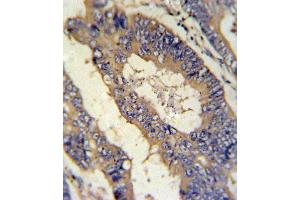 EREG Antibody (C-term) (ABIN650993 and ABIN2840027) IHC analysis in formalin fixed and paraffin embedded colon carcinoma followed by peroxidase conjugation of the secondary antibody and DAB staining. (Epiregulin 抗体  (C-Term))