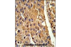 Formalin-fixed and paraffin-embedded human hepatocarcinoma reacted with CYP3A5 Antibody (Center) (ABIN652394 and ABIN2841919) , which was peroxidase-conjugated to the secondary antibody, followed by DAB staining. (CYP3A5 抗体  (AA 186-218))