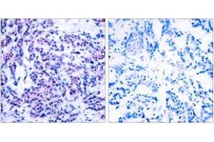Immunohistochemistry analysis of paraffin-embedded human breast carcinoma, using JunD (Phospho-Ser255) Antibody. (JunD 抗体  (pSer255))