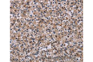 Immunohistochemistry of Human prostate cancer using IPO4 Polyclonal Antibody at dilution of 1:50 (Importin 4 抗体)