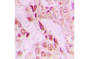 Immunohistochemical analysis of DJ-1 staining in human lung cancer formalin fixed paraffin embedded tissue section. (PARK7/DJ1 抗体  (Center))