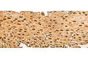 Immunohistochemistry of paraffin-embedded Human cervical cancer tissue using UBLCP1 Polyclonal Antibody at dilution of 1:80(x200) (UBLCP1 抗体)