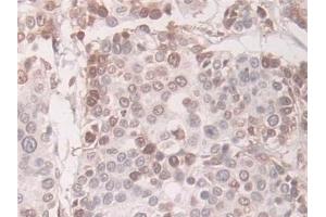 Detection of TAGLN in Human Prostate cancer Tissue using Polyclonal Antibody to Transgelin (TAGLN) (Transgelin 抗体  (AA 1-201))