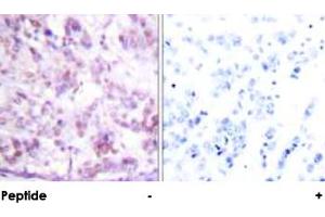 Immunohistochemical analysis of paraffin-embedded human breast carcinoma tissue using MYB polyclonal antibody . (MYB 抗体  (Ser12))