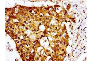 Immunohistochemistry of paraffin-embedded human breast cancer using ABIN7147549 at dilution of 1:100 (CMKLR1 抗体  (AA 321-373))