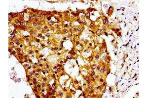 Immunohistochemistry of paraffin-embedded human breast cancer using ABIN7147549 at dilution of 1:100 (CMKLR1 抗体  (AA 321-373))