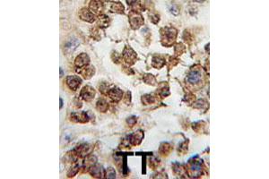 Formalin-fixed and paraffin-embedded human testis tissue reacted with NANOG polyclonal antibody  , which was peroxidase-conjugated to the secondary antibody, followed by DAB staining. (Nanog 抗体  (Internal Region))