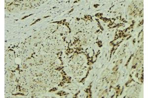ABIN6273056 at 1/100 staining Human breast cancer tissue by IHC-P. (MMS19 抗体  (Internal Region))