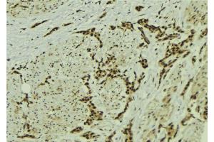 ABIN6273056 at 1/100 staining Human breast cancer tissue by IHC-P. (MMS19 抗体  (Internal Region))